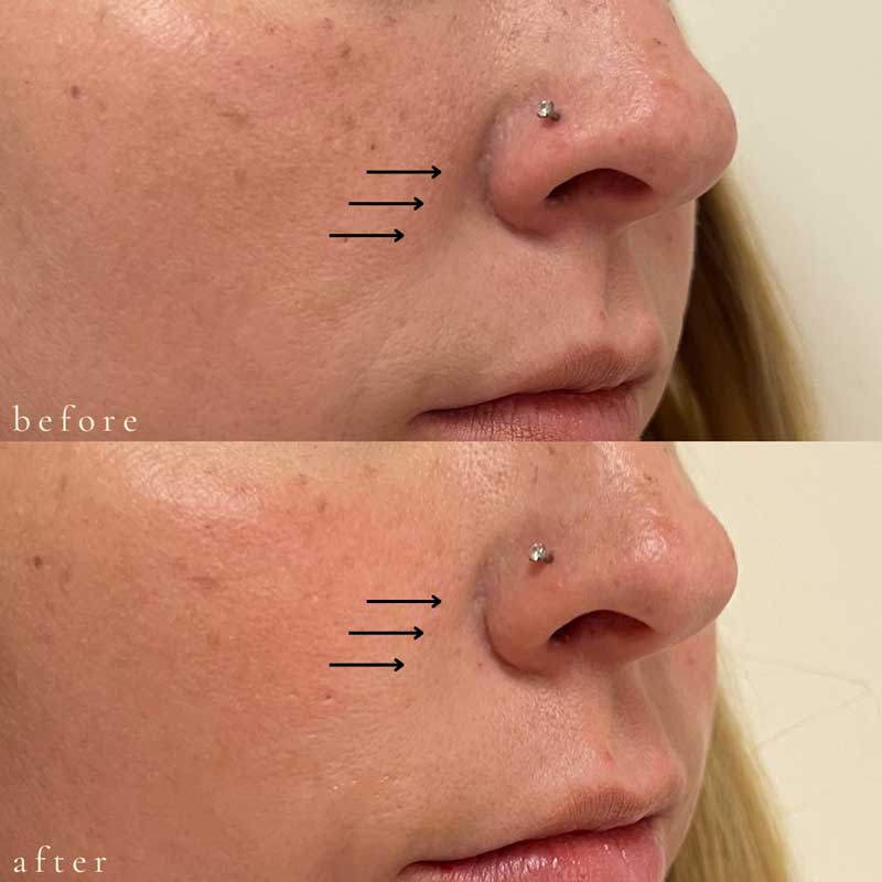 Vollure for Nasolabial Folds